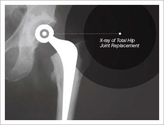 X-ray of Total Knee Joint Replacement