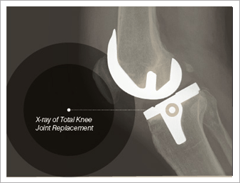 X-ray of Total Knee Joint Replacement